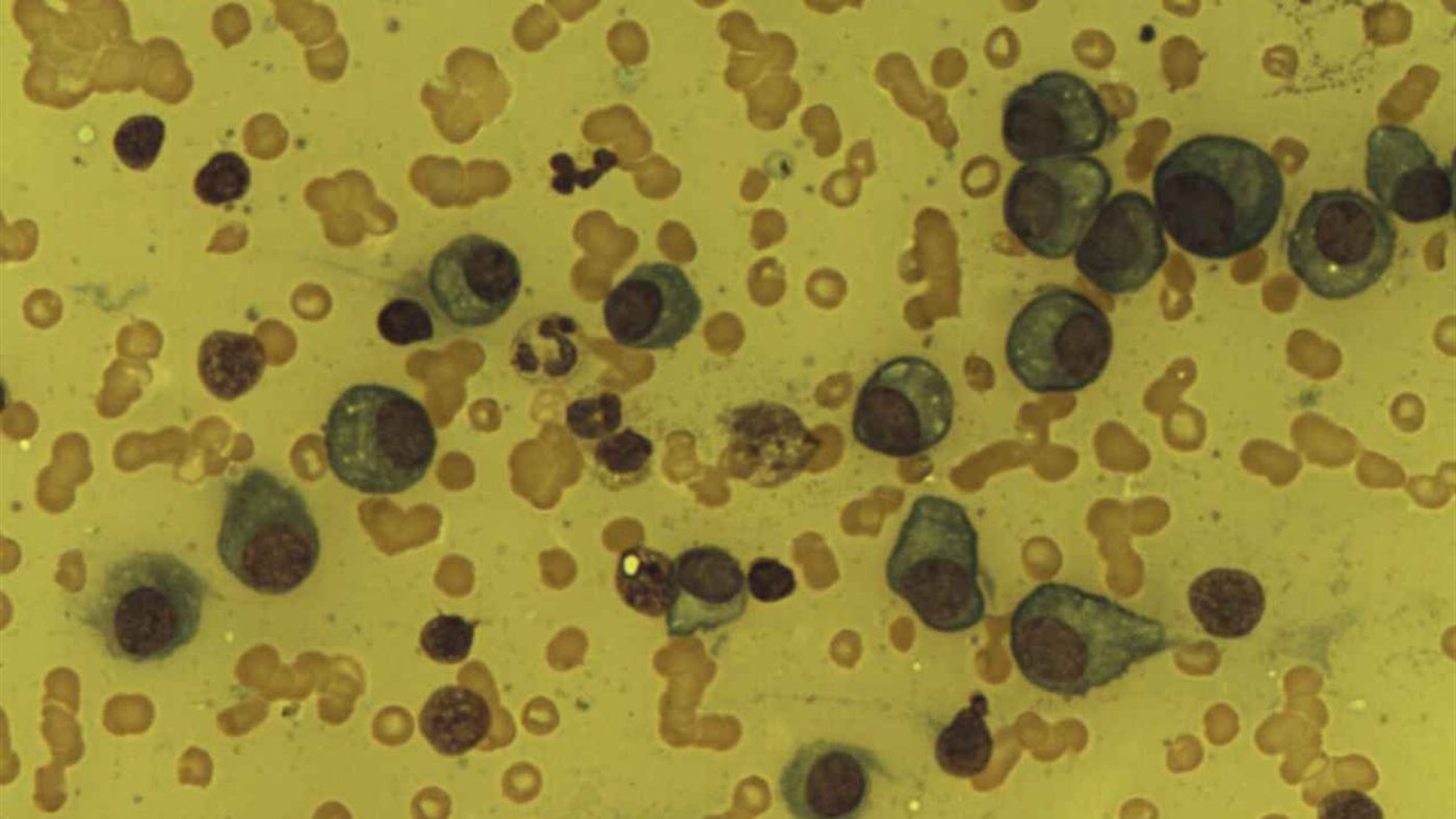 Células de plasma anormais vistas ao microscópio em paciente com mieloma múltiplo