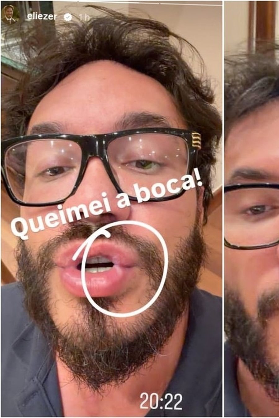 Detalhe da publicação em que o influenciador mostrou os lábios após a queimadura.